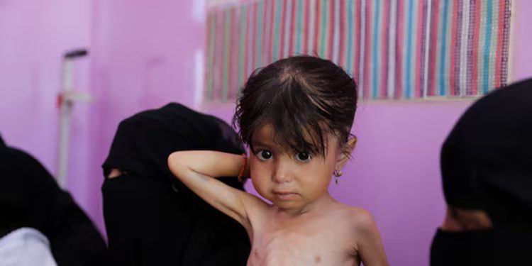 Malnutrition worsening in Yemen’s government-controlled areas, UN says