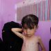 Malnutrition worsening in Yemen’s government-controlled areas, UN says