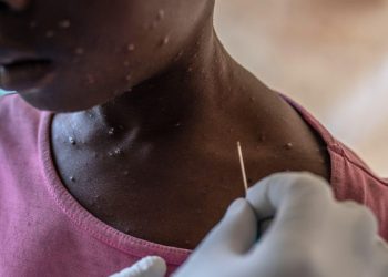 Poor sanitation and supply shortages fuel child mpox deaths in DRC